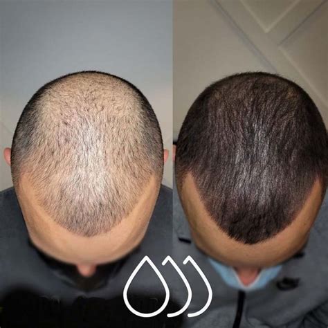 scalp micropigmentation sa|SMP Cost .